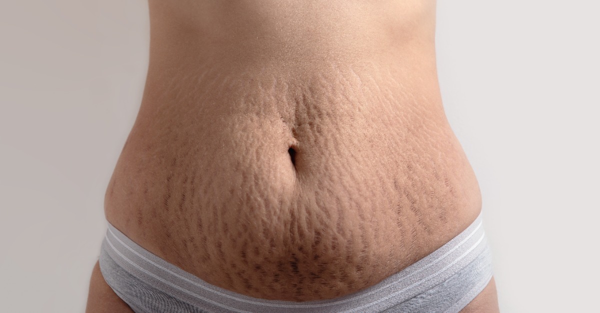 Frustrated by Stretch Marks? Here Are 3 Effective Removal Treatments
