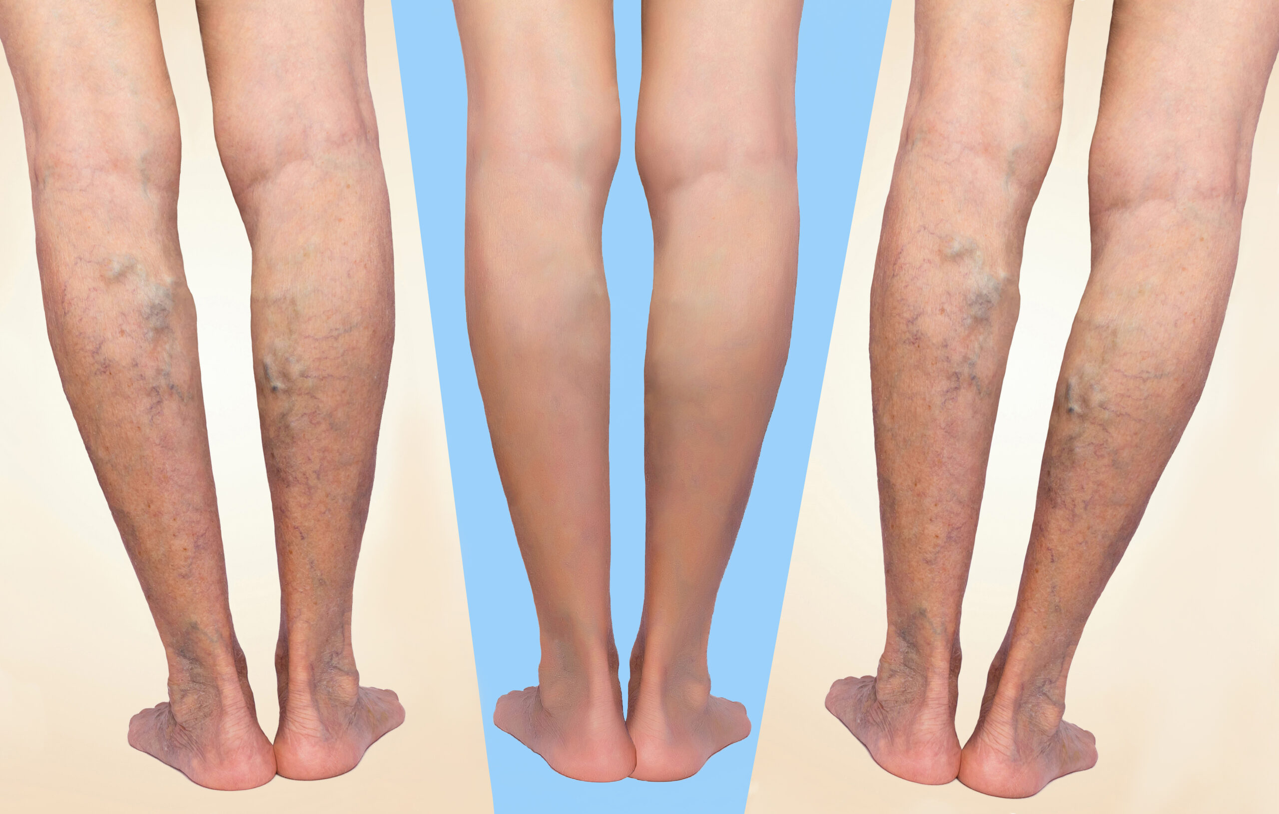 The Best Option For Treating Spider Veins in Commack, New York